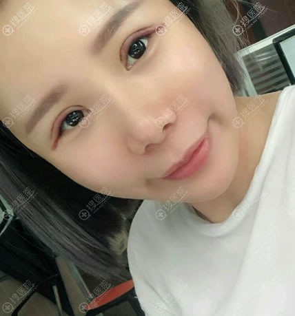 ����˫��Ƥ��֬�����1��Ч��ͼ