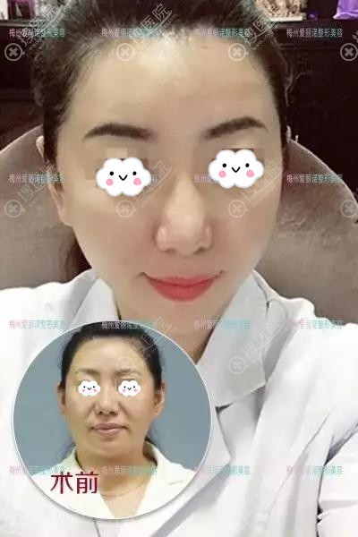 梅州爱丽诺线雕埋线提升真人案例效果对比图 梅州爱丽诺线雕埋线提升真人案例效果对比图