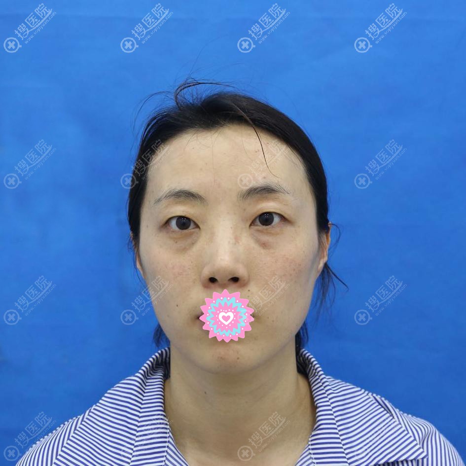 <!--<i data=20240710 data-id=11976></i>-->眼综合手术前照片 <!--<i data=20240710 data-id=11976></i>-->眼综合手术前照片
