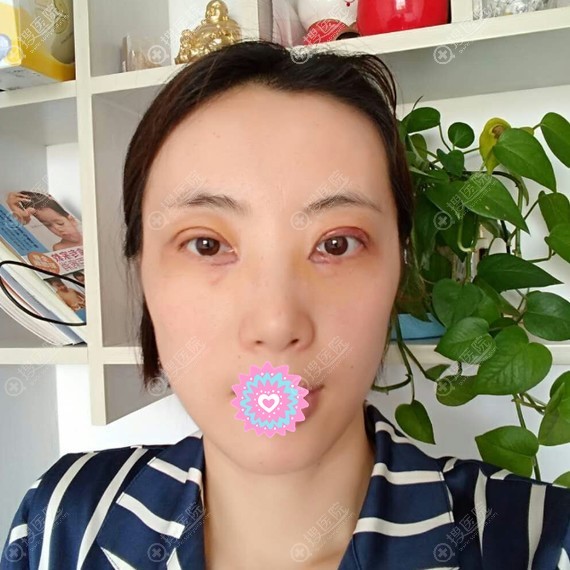 文钟泽院长双眼皮手术后3天 文钟泽院长双眼皮手术后3天
