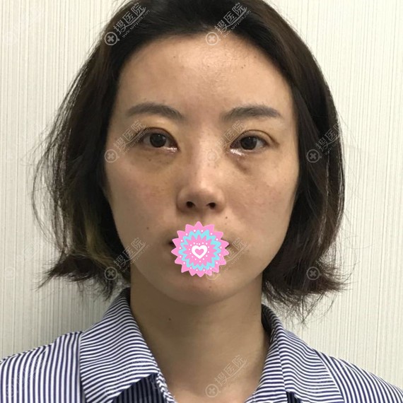 <!--<i data=20240710 data-id=11976></i>-->双眼皮术后7天恢复图 <!--<i data=20240710 data-id=11976></i>-->双眼皮术后7天恢复图