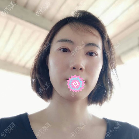 文钟泽眼综合手术1个月效果图 文钟泽眼综合手术1个月效果图