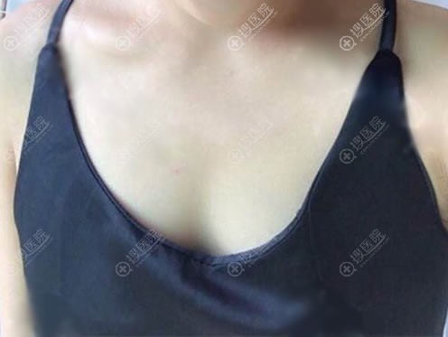 大三的我勇敢叩开了北京壹加壹王珂医生之门做了自体脂肪隆胸