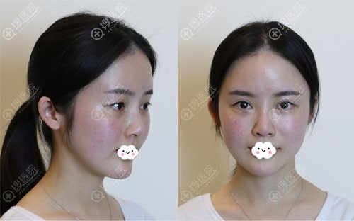 重庆艺星金辉假体隆鼻综合整形真人案例 重庆艺星金辉假体隆鼻综合整形真人案例