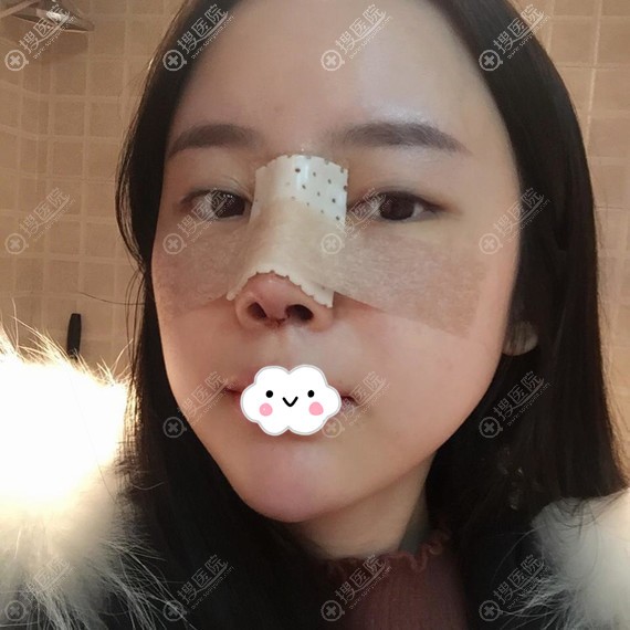重庆艺星金辉鼻综合术后3天效果 重庆艺星金辉鼻综合术后3天效果
