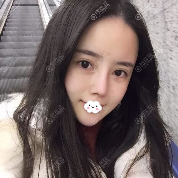 重庆隆鼻哪家医院好?重庆艺星鼻综合案例 重庆隆鼻哪家医院好?重庆艺星鼻综合案例