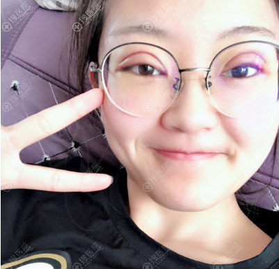 苏州美贝尔陈光医生双眼皮案例2天自拍 苏州美贝尔陈光医生双眼皮案例2天自拍