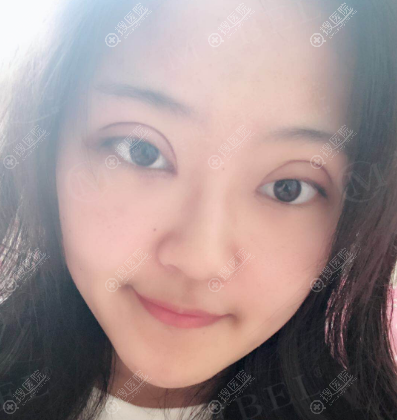 苏州美贝尔双眼皮案例7天效果图 苏州美贝尔双眼皮案例7天效果图