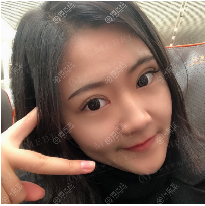 苏州美贝尔做双眼皮怎么样 苏州美贝尔做双眼皮怎么样