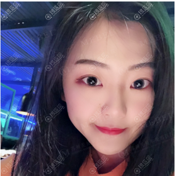 庆幸听苏州美贝尔陈光的建议双眼皮没有割太宽,现在的宽度正好