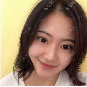 苏州美贝尔陈光双眼皮案例宽度刚刚好 苏州美贝尔陈光双眼皮案例宽度刚刚好