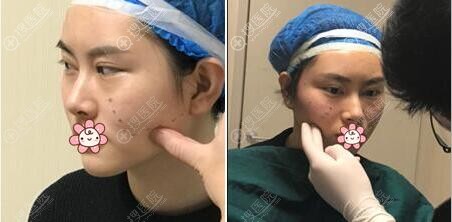面部线雕提升术前设计 面部线雕提升术前设计