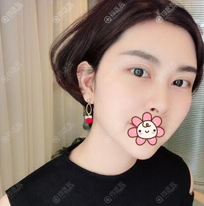 深圳美莱线雕术后15天恢复效果 深圳美莱线雕术后15天恢复效果
