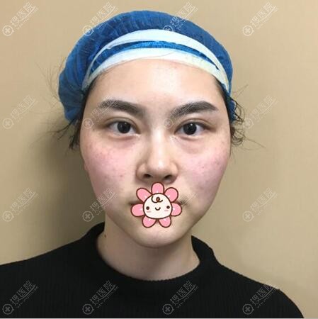 黄海龙线雕提升面部术后即刻 黄海龙线雕提升面部术后即刻