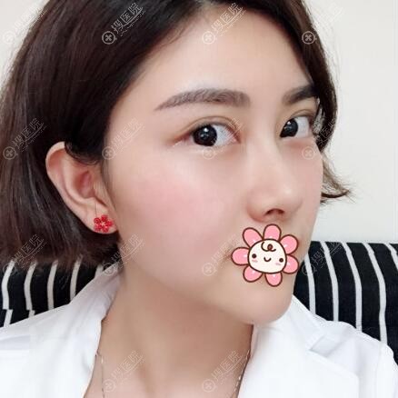 深圳美莱黄海龙面部线雕提升术后效果图 深圳美莱黄海龙面部线雕提升术后效果图