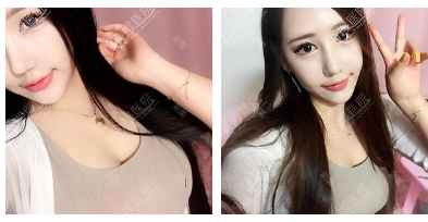 苏州美贝尔聂志宏做隆胸怎么样 苏州美贝尔聂志宏做隆胸怎么样