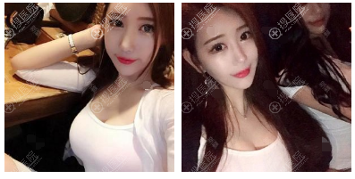 苏州美贝尔聂志宏双眼皮隆鼻隆胸案例 苏州美贝尔聂志宏双眼皮隆鼻隆胸案例