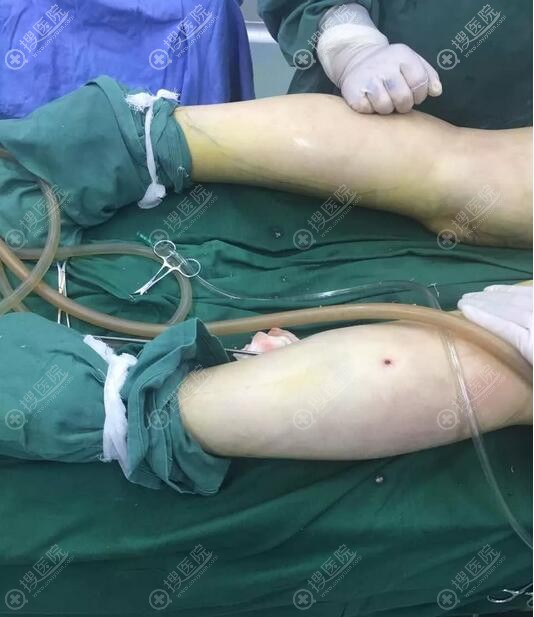 深圳南雅整形美容医院潘龙升大腿吸脂手术中 深圳南雅整形美容医院潘龙升大腿吸脂手术中