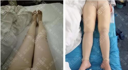 潘龙升大腿吸脂术后即刻效果 潘龙升大腿吸脂术后即刻效果
