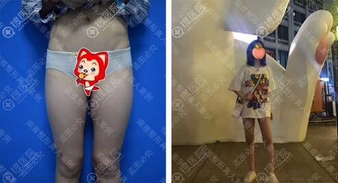 深圳南雅整形医院宝丽太大腿吸脂前后对比 深圳南雅整形医院宝丽太大腿吸脂前后对比