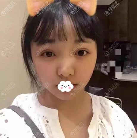 在重庆华美找李任做了耳软骨隆鼻为了更漂亮还打了玻尿酸丰下巴