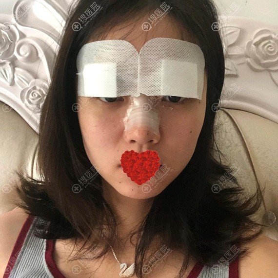 假体隆鼻恢复3天效果 假体隆鼻恢复3天效果