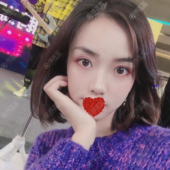 <!--<i data=20240710 data-id=17289></i>-->隆鼻术1个月 <!--<i data=20240710 data-id=17289></i>-->隆鼻术1个月