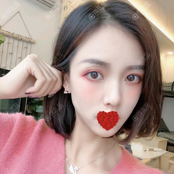 <!--<i data=20240710 data-id=17289></i>-->硅胶隆鼻术后2个月案例 <!--<i data=20240710 data-id=17289></i>-->硅胶隆鼻术后2个月案例