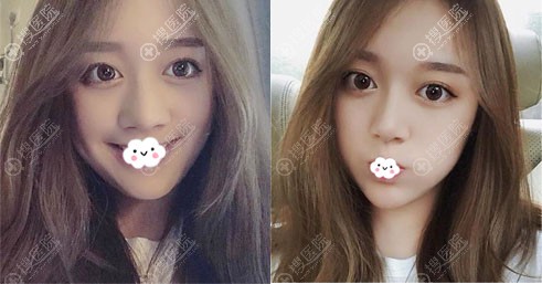 广东画美张勇硅胶假体隆鼻综合整形案例前后对比图 广东画美张勇硅胶假体隆鼻综合整形案例前后对比图