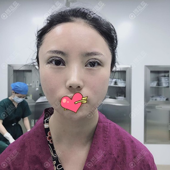 双眼皮修复术后眼睛是肿的 双眼皮修复术后眼睛是肿的