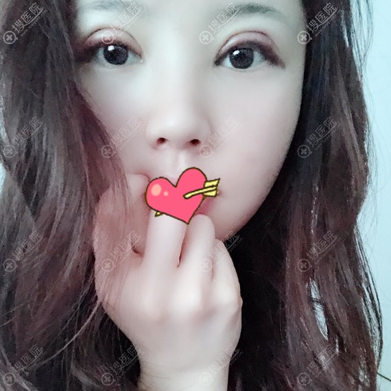 吴明龙双眼皮修复术后3天 吴明龙双眼皮修复术后3天