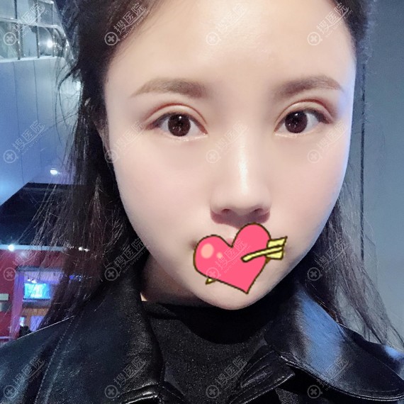 吴明龙双眼皮恢复15天效果 吴明龙双眼皮恢复15天效果