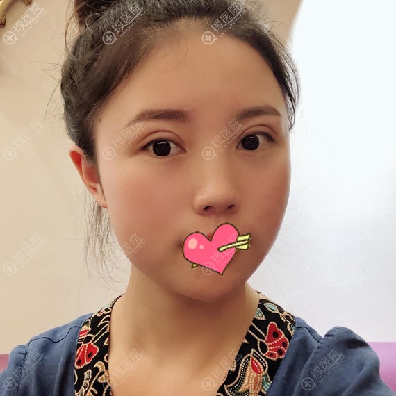 吴明龙双眼皮修复一个月恢复的很自然 吴明龙双眼皮修复一个月恢复的很自然