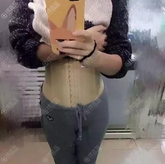 腰部吸脂术后穿塑身衣效果 腰部吸脂术后穿塑身衣效果