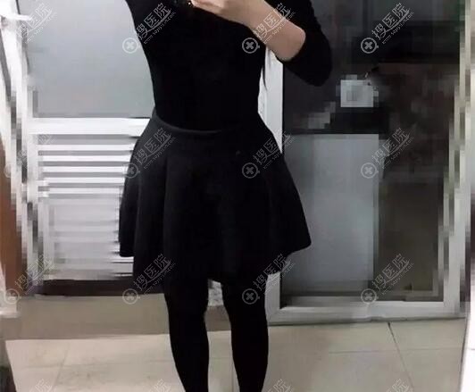 <!--<i data=20240710 data-id=12133></i>-->腰腹吸脂术后效果 <!--<i data=20240710 data-id=12133></i>-->腰腹吸脂术后效果