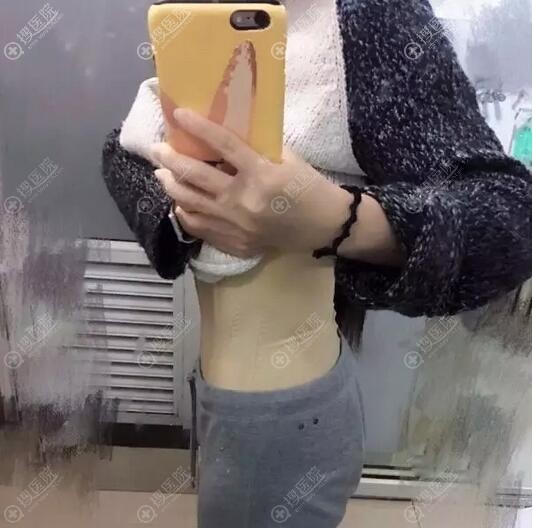 腰腹吸脂术后侧面照 腰腹吸脂术后侧面照
