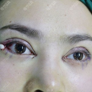 <!--<i data=20240710 data-id=12731></i>-->巩永强双眼皮+开内外眼角真人案例 <!--<i data=20240710 data-id=12731></i>-->巩永强双眼皮+开内外眼角真人案例