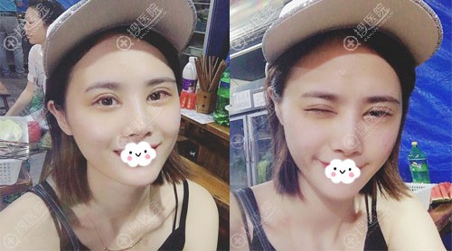 <!--<i data=20240710 data-id=12731></i>-->巩永强眼部综合整形术后1周效果 <!--<i data=20240710 data-id=12731></i>-->巩永强眼部综合整形术后1周效果