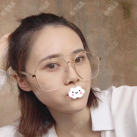 <!--<i data=20240710 data-id=12731></i>-->巩永强双眼皮+开眼角术后15天恢复图 <!--<i data=20240710 data-id=12731></i>-->巩永强双眼皮+开眼角术后15天恢复图