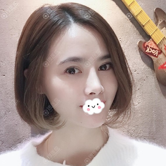 <!--<i data=20240710 data-id=12731></i>-->割双眼皮效果怎么样?巩永强眼综合案例恢复图 <!--<i data=20240710 data-id=12731></i>-->割双眼皮效果怎么样?巩永强眼综合案例恢复图