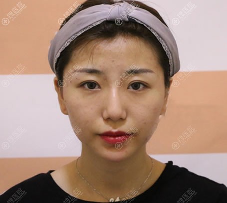 赶在年前到北京长虹做自体脂肪填充全脸和整鼻子好好美了一把