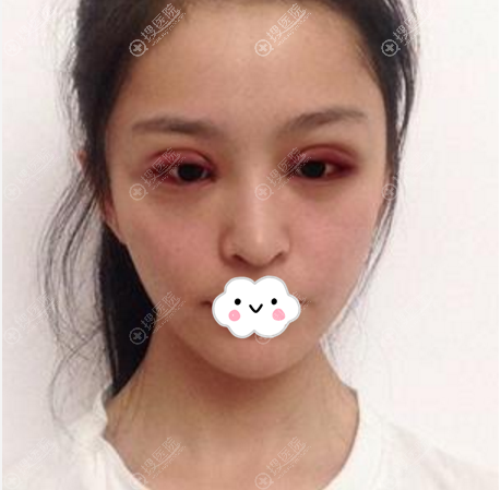 杭州时光双眼皮案例术后效果图 杭州时光双眼皮案例术后效果图