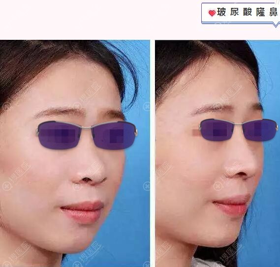 贵阳美贝尔玻尿酸隆鼻案例效果对比图 贵阳美贝尔玻尿酸隆鼻案例效果对比图