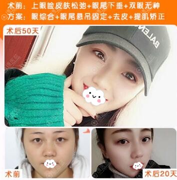 贵阳美贝尔切开双眼皮真人案例 贵阳美贝尔切开双眼皮真人案例