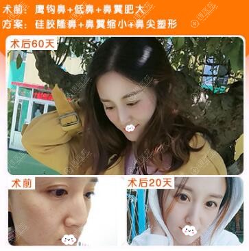 贵阳美贝尔硅胶假体隆鼻案例效果对比图 贵阳美贝尔硅胶假体隆鼻案例效果对比图