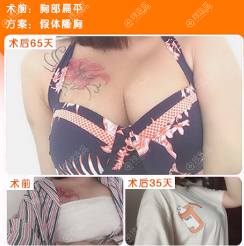 贵阳美贝尔假体隆胸案例恢复效果图 贵阳美贝尔假体隆胸案例恢复效果图