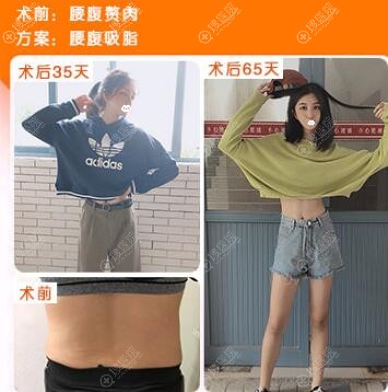 贵阳美贝尔腰腹吸脂案例对比图 贵阳美贝尔腰腹吸脂案例对比图