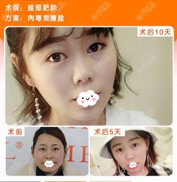 贵阳美贝尔注射瘦脸除皱案例效果对比 贵阳美贝尔注射瘦脸除皱案例效果对比