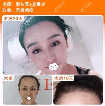 贵阳美贝尔发际线种植案例恢复效果图 贵阳美贝尔发际线种植案例恢复效果图