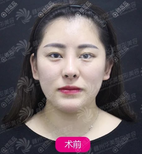 找赣州华美牛先翠做完面部吸脂,成功从XL号大脸变成XS号小脸